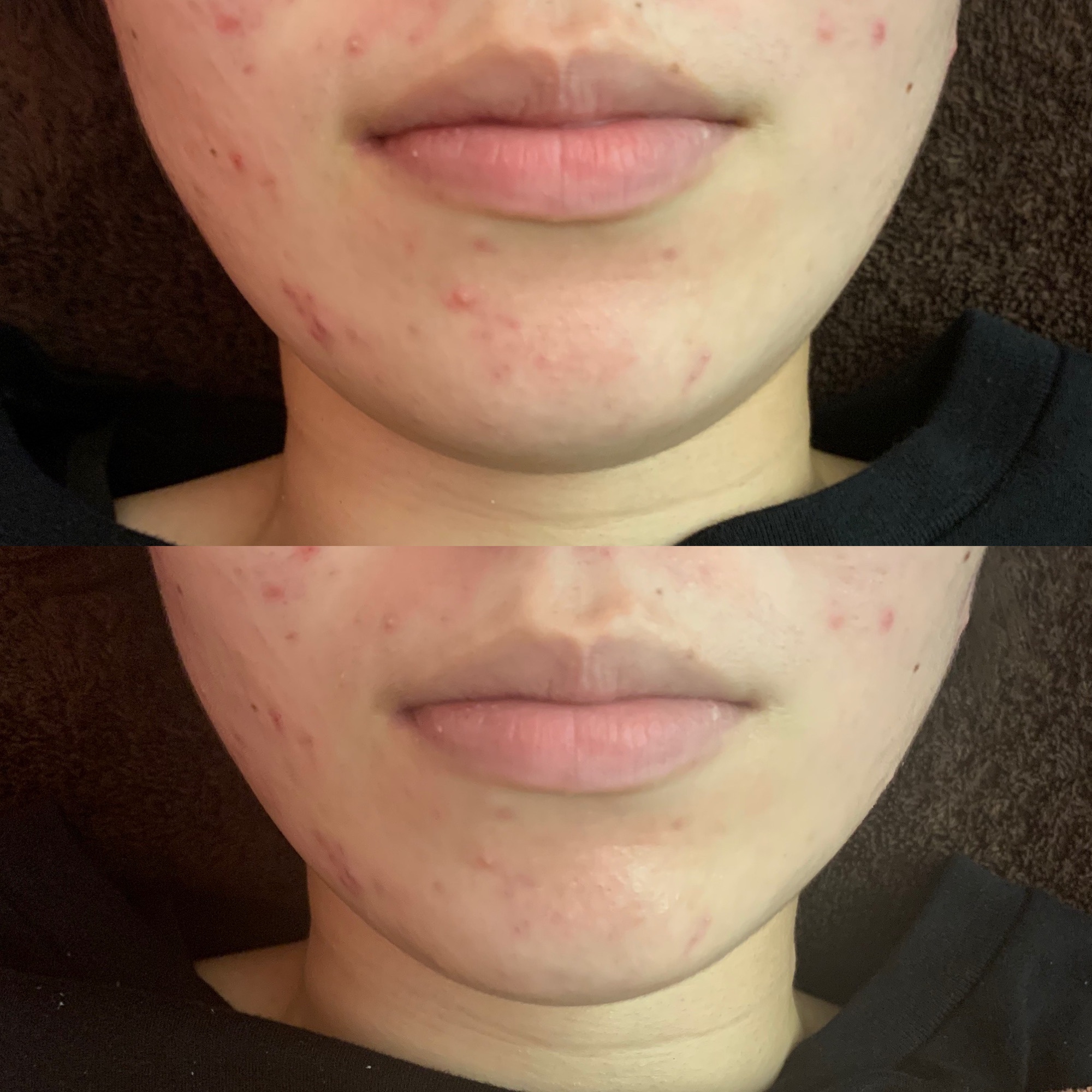 ビフォーアフター エミルカ