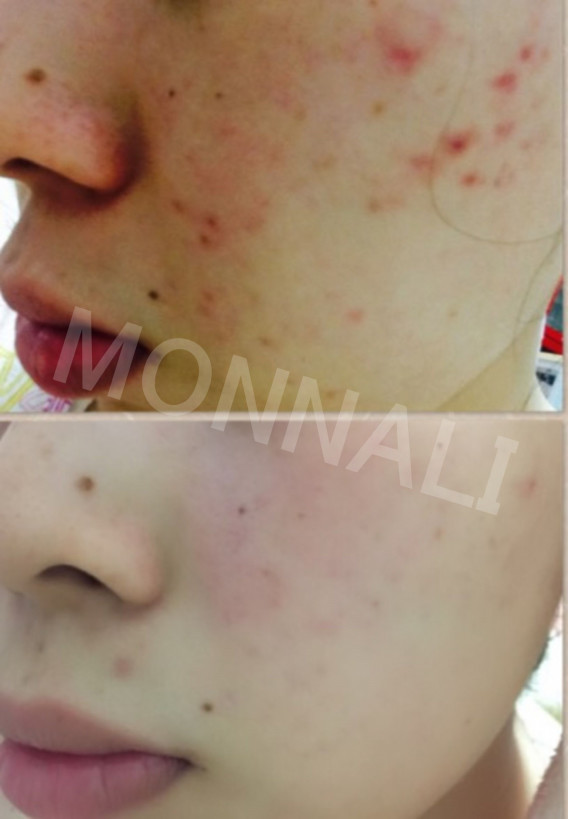 クリスタルケア ハーブピーリング Maison De L Embellir