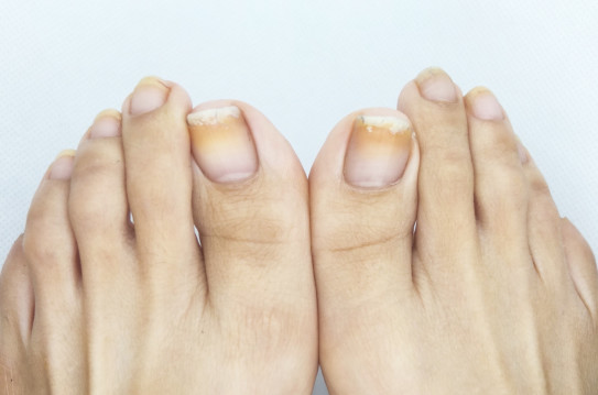 色素沈着しておりました 仙川ネイルサロンminet ミネット