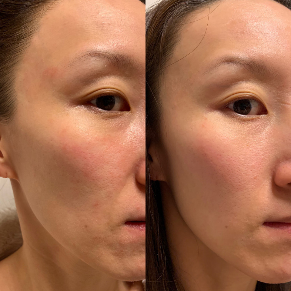 エンビロントリートメント Cクエンスを使用した経過 Mari美容鍼灸エステ 奈良