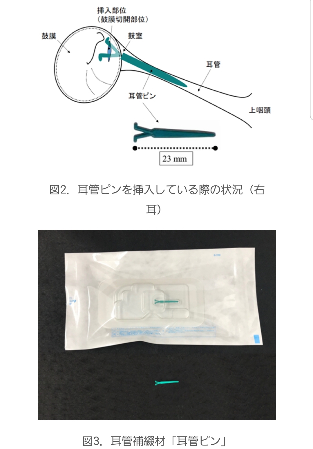 耳管ピン治療 耳管開放症治療 | 医療法人社団誠心会 あすみが丘