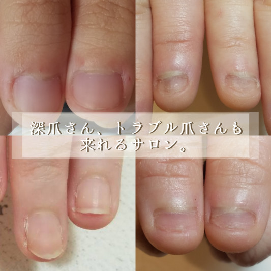 深爪さんやトラブル爪さんもご来店いただけるサロンです Nail Atelier Beeds