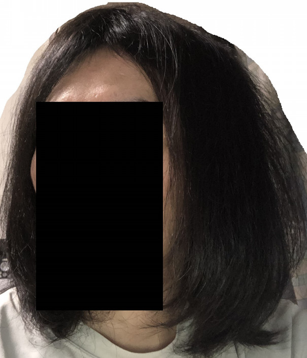 髪の毛 成長記録 すっかりロン毛 僕らのミノキ日記 Aga克服 髪の毛 成長記録 すっかりロン毛 僕らのミノキ日記 Aga克服
