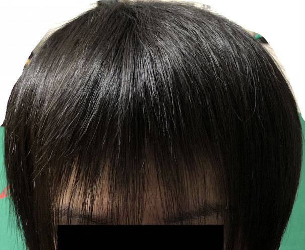 髪の毛 成長記録 僕らのミノキ日記 Aga克服 髪の毛 成長記録 僕らのミノキ日記 Aga克服