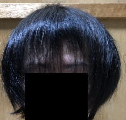 髪の毛成長記録 僕らのミノキ日記 Aga克服