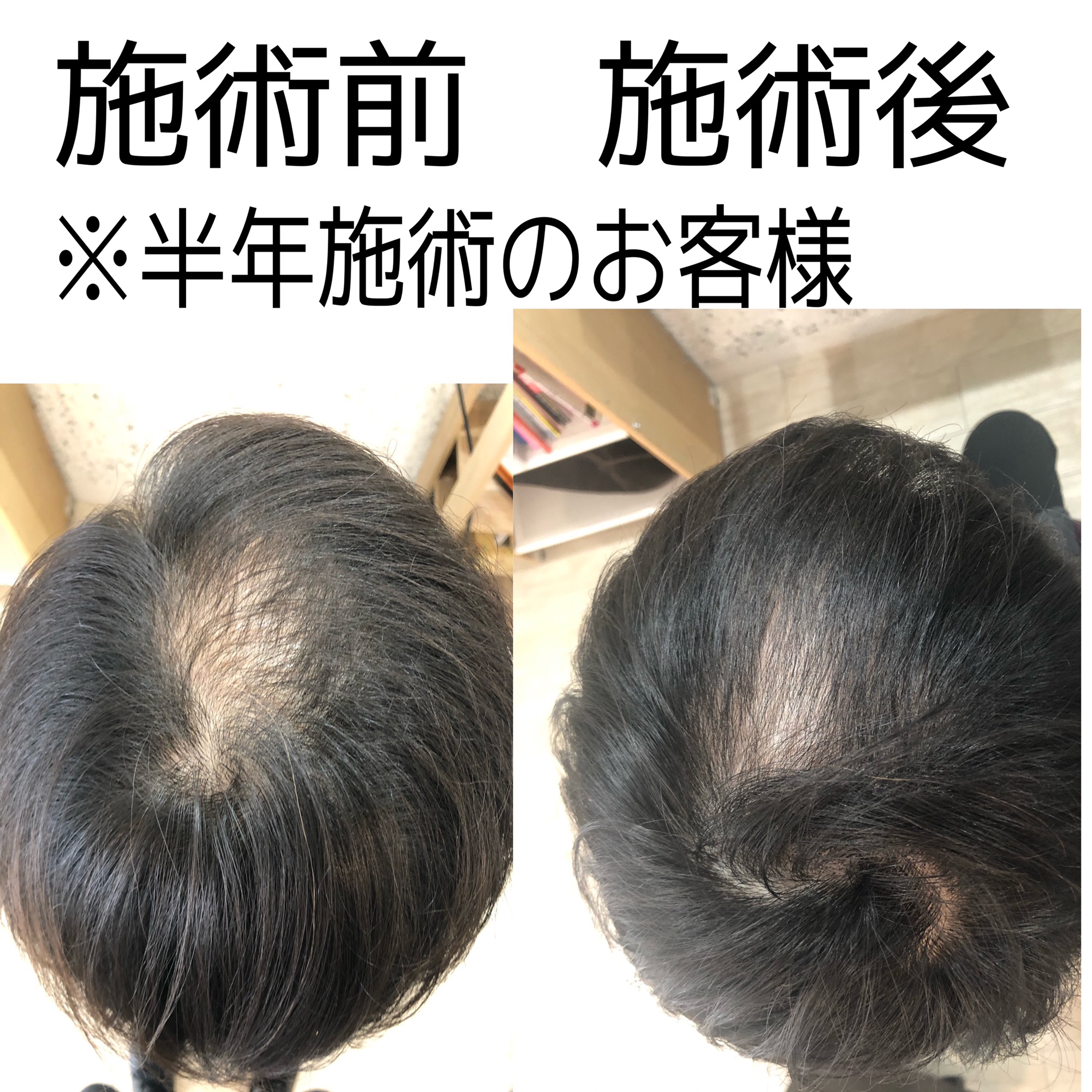 ヒト幹細胞培養液で美容室で育毛できます