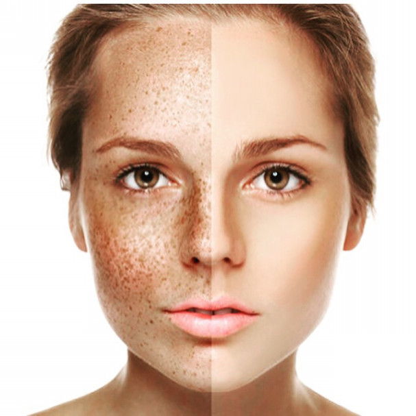 シミ くすみを無くすには エステサロンcrystal