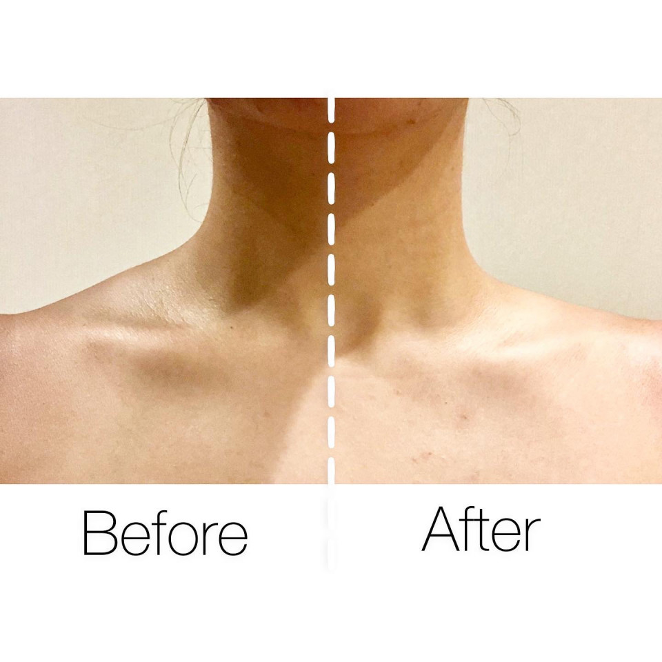 肩の盛り上がり 僧帽筋が硬い 老廃物が溜まっている セルフエステ専門店 高輪ゲートウェイ店 表参道店 ラグラン銀座メディカルエステ