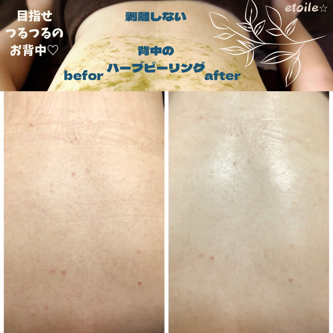 ハーブピーリング 剥離あり 漢方医薬所製造 医薬ハーブ 背中