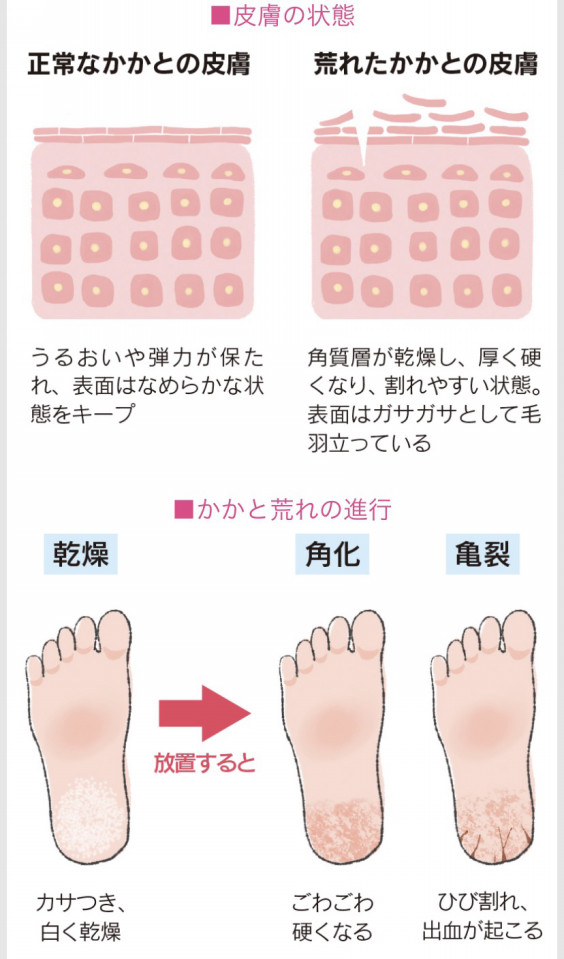 かかとがカサカサになる原因 Mstnail