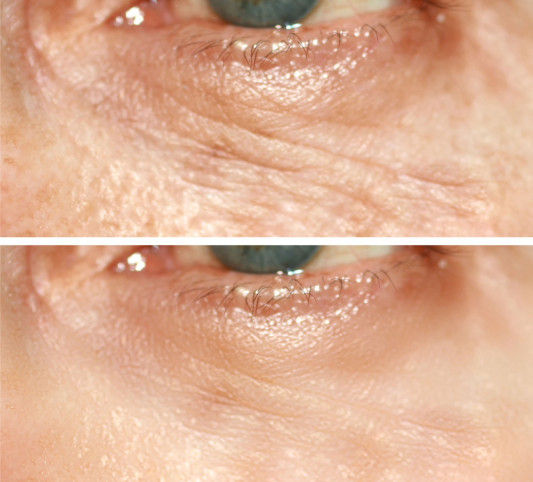 目の下のたるみは整形で改善できる おすすめのクリニック３選 Cosmetic Surgery Info 2