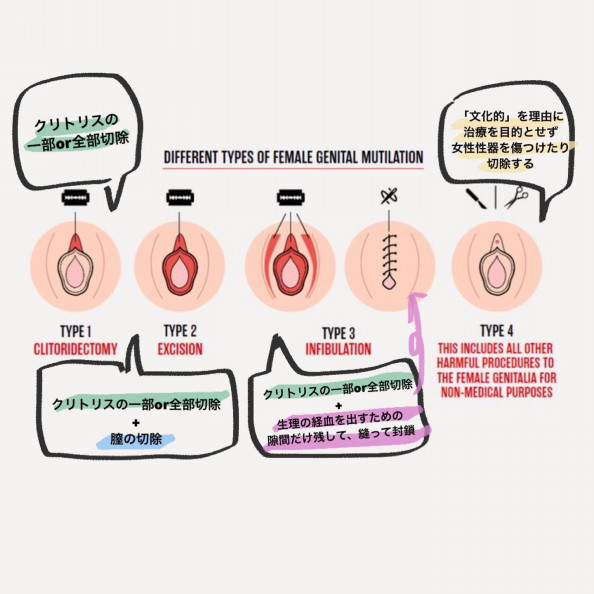 女性性器切除 Up To Me