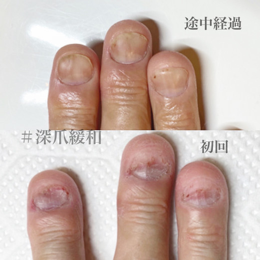 埼玉県 和光市 東京 池袋 深爪専門ネイルサロンmeremerpetit メールメールプチ 深爪 の記事一覧 ページ0