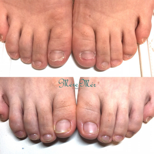 17年08月の記事一覧 ページ1 埼玉県 和光市 東京 池袋 深爪専門ネイルサロンmeremerpetit メールメールプチ 深爪