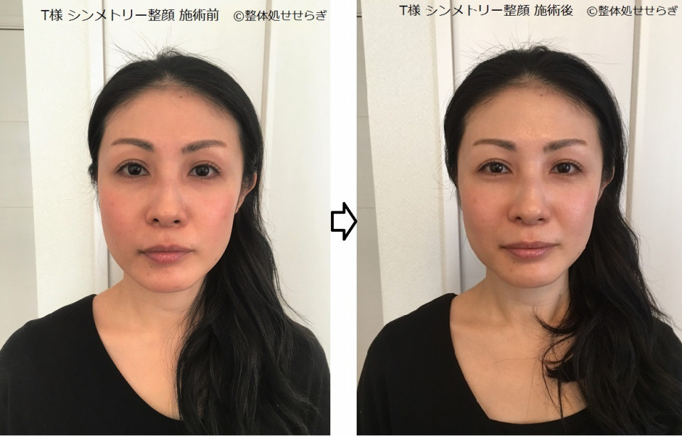 鼻の歪みにお悩みの方のシンメトリー整顔のビフォー アフター写真 横浜白楽 整体処せせらぎ