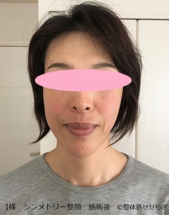 左右の頬の形が異なることにお悩みの方のシンメトリー整顔ビフォー アフター写真 横浜白楽 整体処せせらぎ
