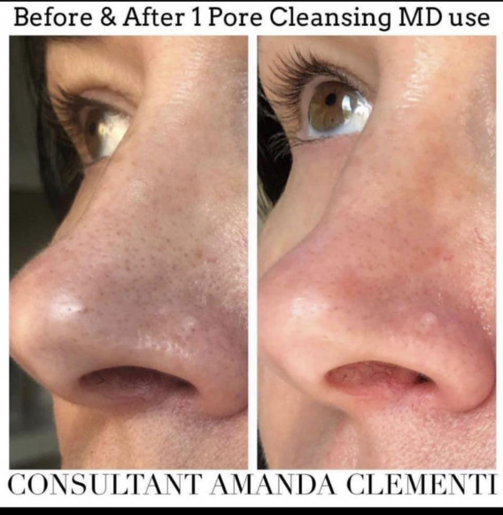 🌴毛穴大掃除クリーナー - Pore cleansing MD System - | Beauty for  