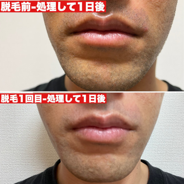 脱毛経過報告 Any