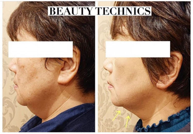 ウル5ゴールドハイフ Lilas Beauty リラビューティー ウル5ゴールドハイフ Lilas Beauty リラビューティー